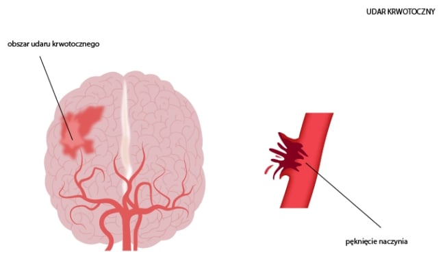 Кровь, вытекающая из поврежденного сосуда, разрушает окружающую нервную ткань и вызывает повышение давления внутри черепа, что нарушает работу всего мозга (а не только клеток в области инсульта)