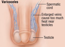 Гормональные проблемы , такие как низкий уровень   тестостерон   или же   щитовидная железа   гормон   Проблемы с яичками , включая аномальный рост или развитие, или повреждение от травмы и инфекций   Проблемы с потоком сперматозоидов в мужских репродуктивных органах , включая закупоренные трубки, которые транспортируют сперму, половые инфекции, варикозное расширение вен (мариноцеле) в мошонке или проблемы с эякуляцией