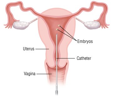 При экстракорпоральном оплодотворении яйцеклетки удаляются хирургическим путем из партнера женского пола, объединяются со спермой в лаборатории, а затем хирургически заменяются в матке
